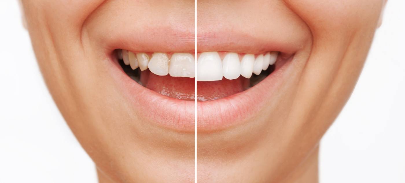 Before/after closeup of a smile that’s half damaged and half restored with veneers