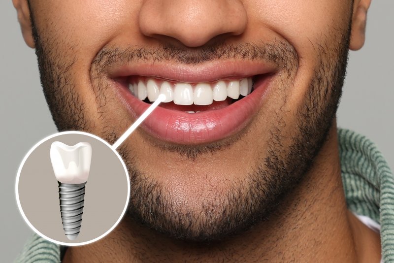 A picture highlighting a man’s front tooth dental implant